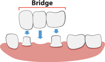 Waukee dentists at Lush Family Dental share all you need to know about dental bridges to fill the gap and restore your smile.
