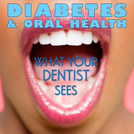 Waukee dentists, Drs. Michael & Blake Louscher of Lush Family Dental, discuss the side effects of diabetes and how it affects your oral health.