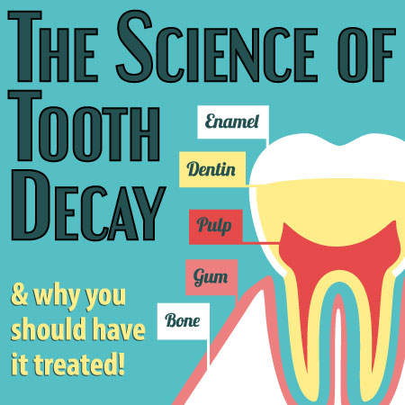 Waukee dentists, Drs. Michael & Blake Louscher of Lush Family Dentistry, discuss the science of tooth decay: what it is and what you can do to prevent it.